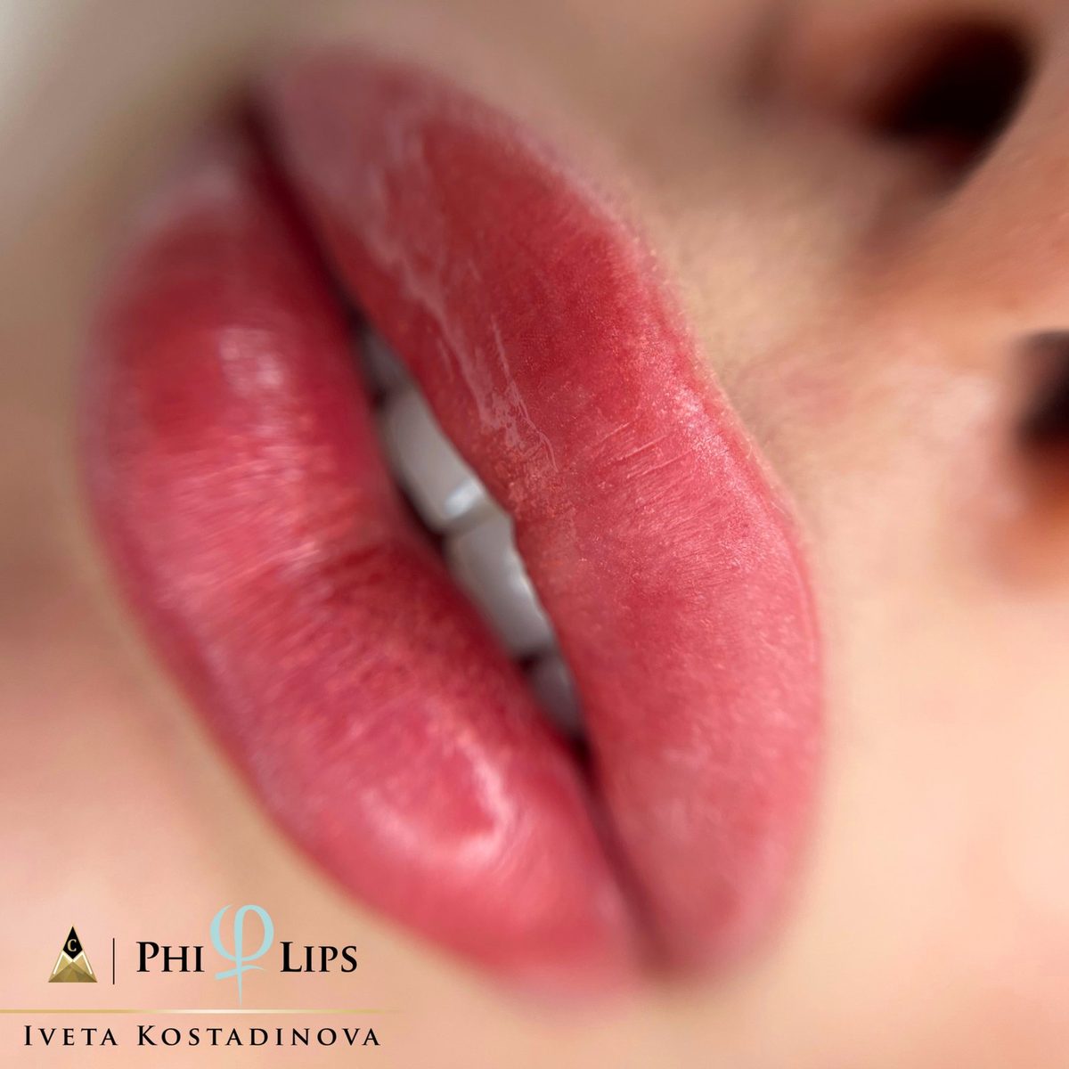 PhiLips резултат — микропигментация на устни